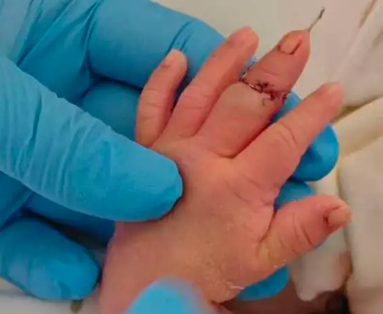 新生儿疑被助产士剪断手指，家属：已申请医疗事故鉴定