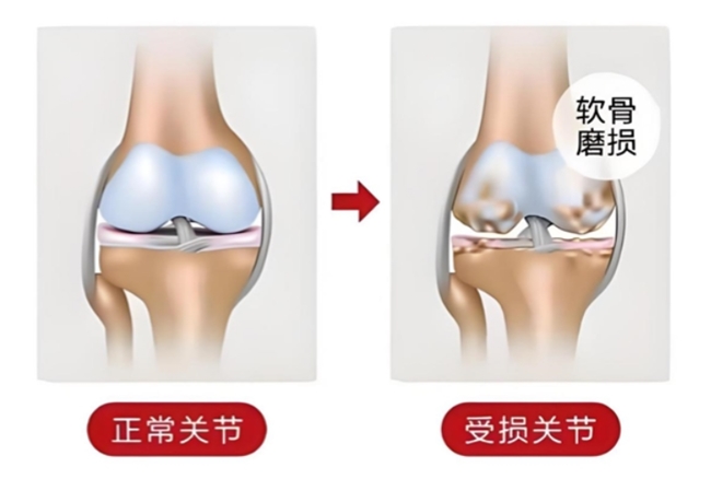 骨关节炎冬季养护指南：分清硫酸和盐酸氨基葡萄糖胶囊区别