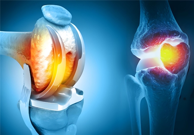 硫酸和盐酸氨基葡萄糖胶囊区别要明晰,应对骨关节炎更从容!