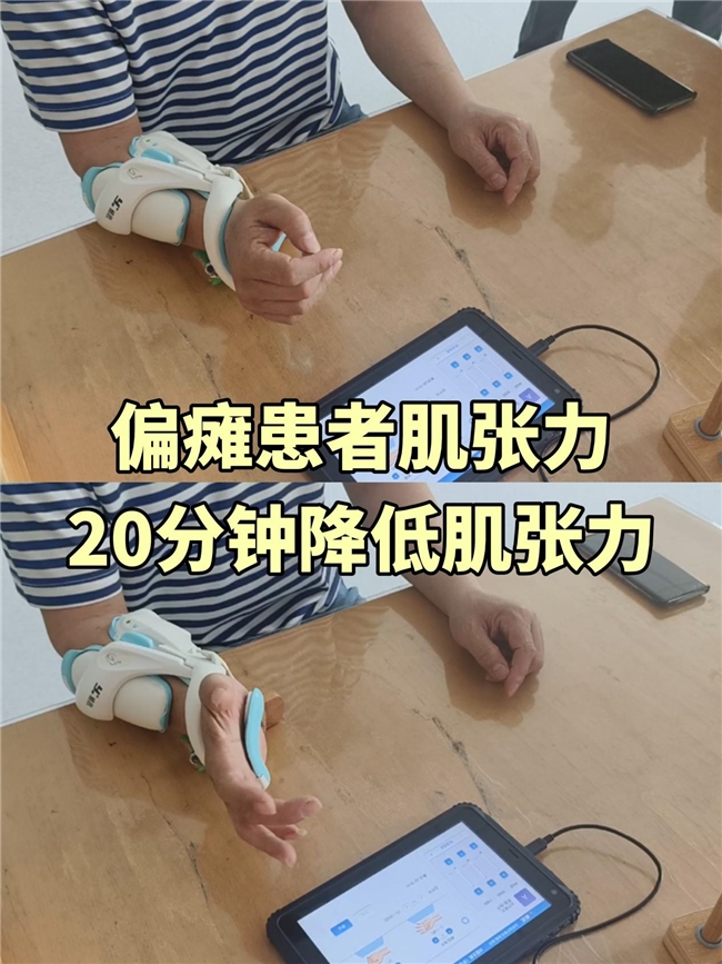 常州“雅思”医疗FES系统助力中风偏瘫患者重获行走能力